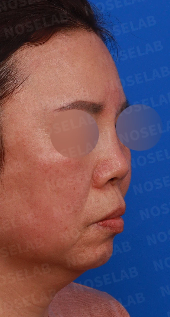 불법 주사 시술 뒤 코가 들리고 짧아지는 이유, 이물질 제거와 재건은 어떻게 하나 — 디자인 상담 우측 비스듬한 측면, 측면, 비공 사진