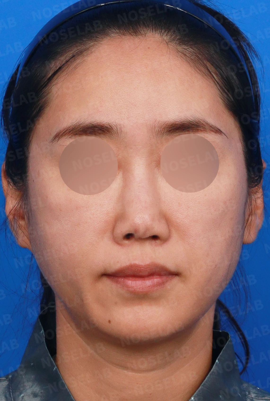 콧대에 주입한 불법 시술 이물질, 제거와 비중격 전체 재건은 어떻게 하나 — 디자인 상담 정면, 좌측 비스듬한 측면, 측면 사진입니다.