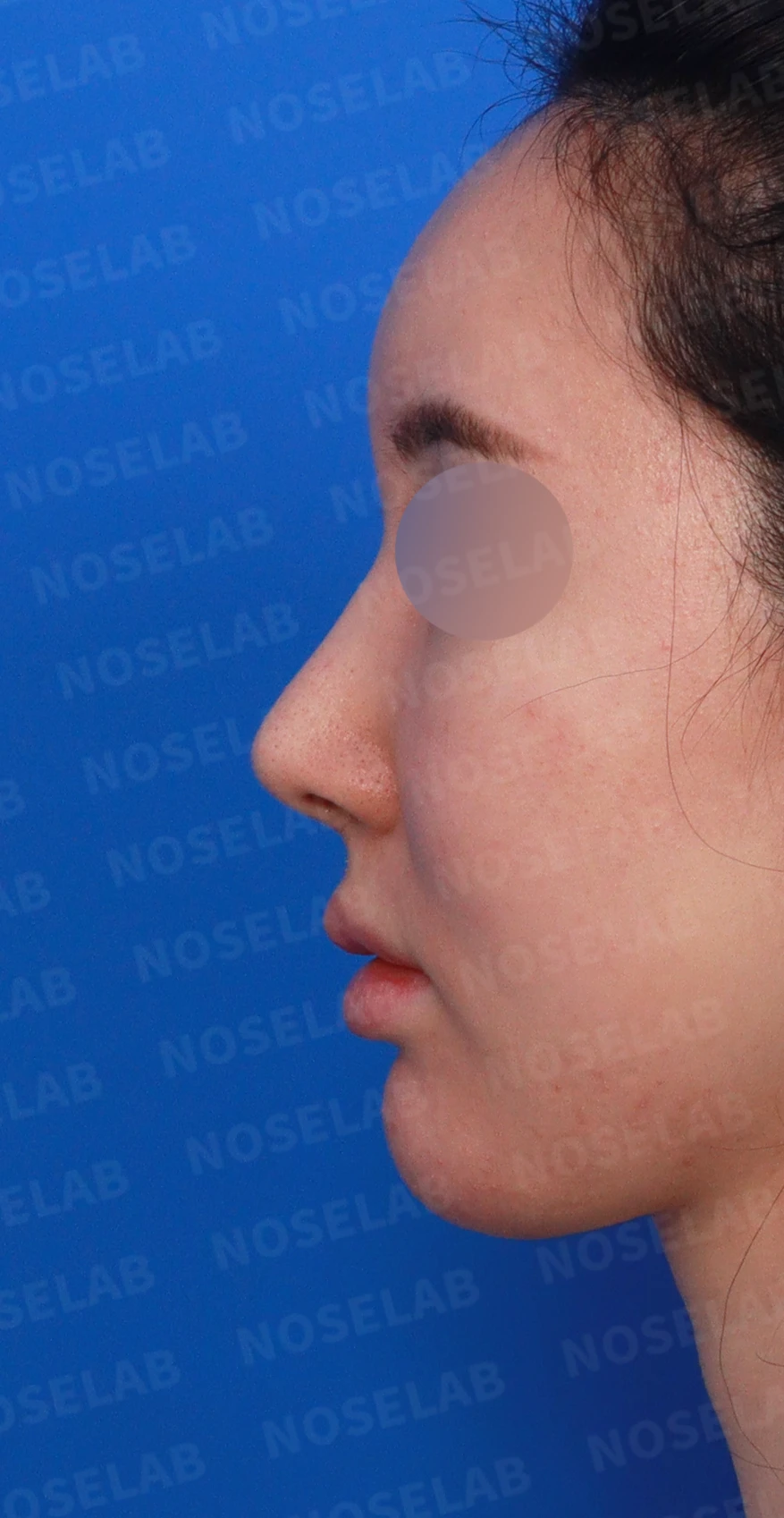 코가 길어 보이고 비주가 휘는 이유, 비중격 연장과 재건은 어떻게 하나 — 디자인 상담 정면, 좌측 측면, 비스듬한 측면 사진