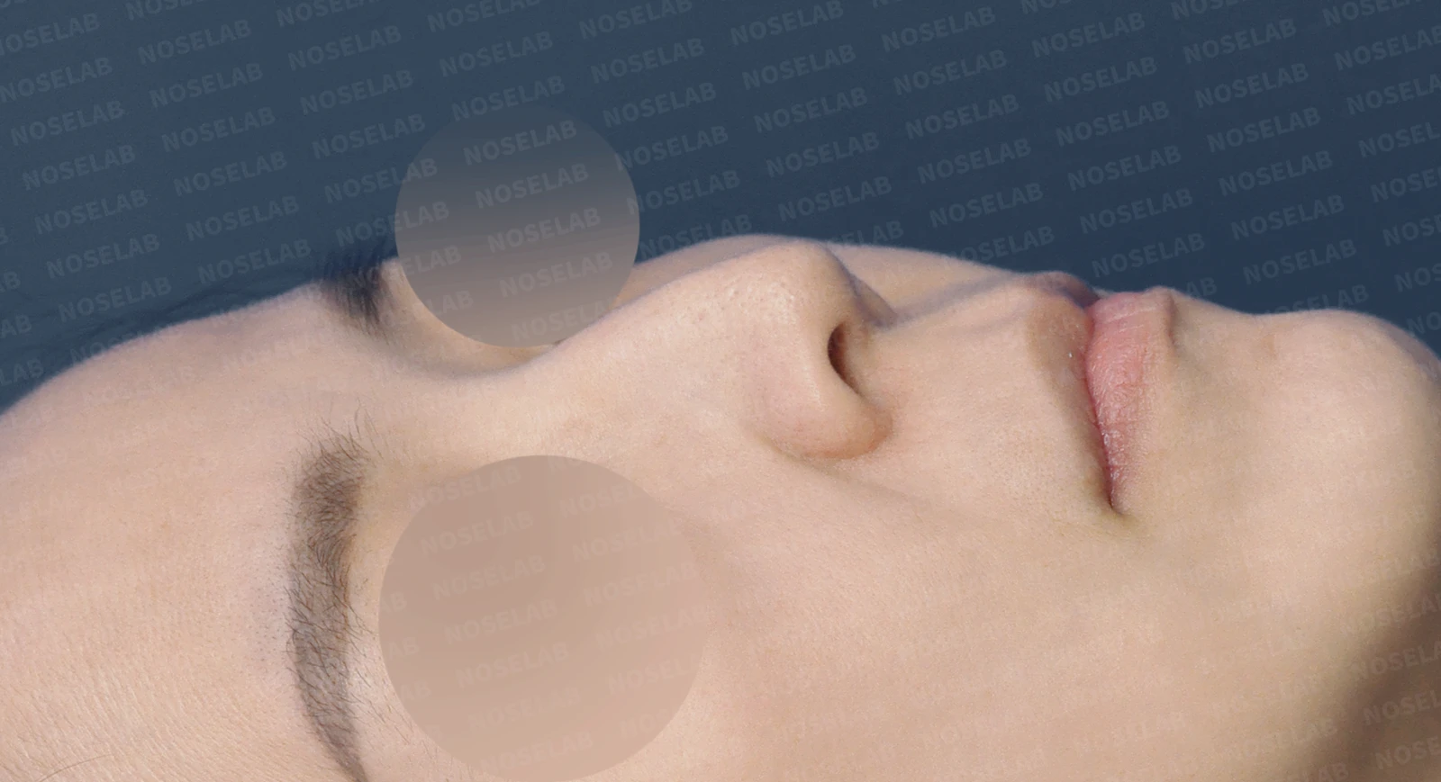 들창코, 매부리코, 휜코까지 한번에 완벽 교정! — 수술전(좌) 수술직후(우)