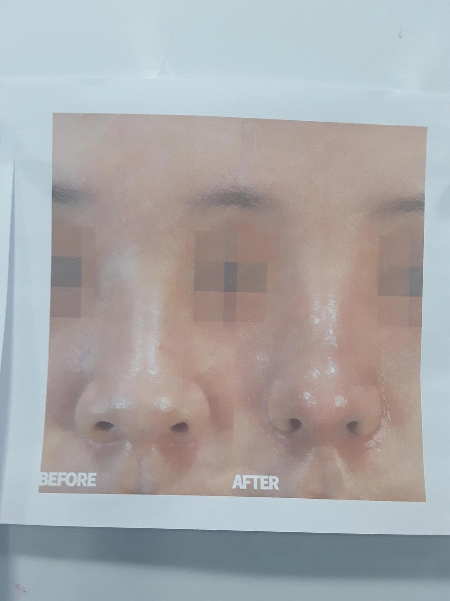 코재수술 뒤 콧대가 붉어 보이는 이유와 재건 방법 — 환자분 원하시는 이미지 사진들입니다.