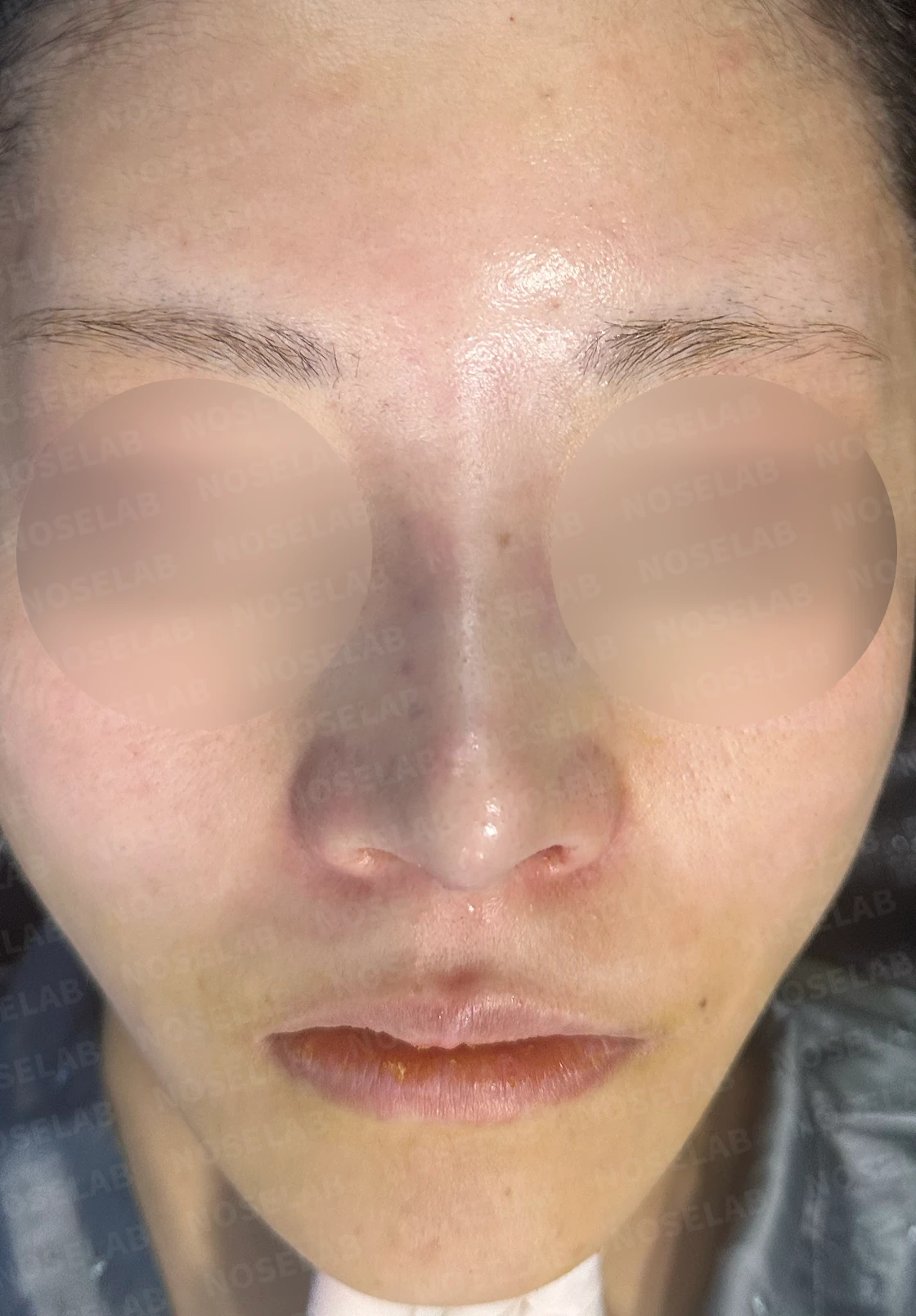 필러 맞고 퍼진 코 교정 방법 — 수술 전 / 수술 직후 0일 직후 사진은 부기가 있는 상태로 최종 결과와 다를 수 있습니다.