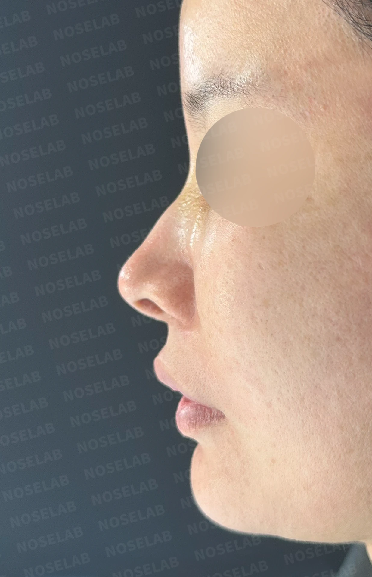 외상으로 코뼈가 부러지면 코가 어떻게 변형되고, 정복과 재건은 어떻게 하나 — 수술 전 / 수술 직후 0일 직후 사진은 부기가 있는 상태로 최종 결과와 다를 수 있습니다.