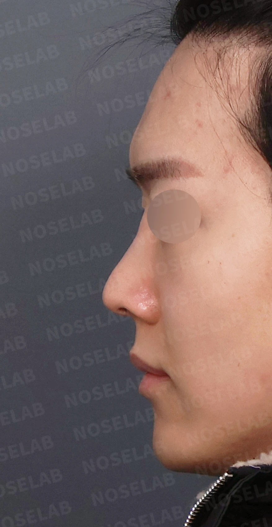 코가 낮아 보이는 이유와 자가 늑연골로 높이를 만드는 방법 — 디자인 상담 정면, 좌측 측면, 비스듬한 측면 사진입니다.