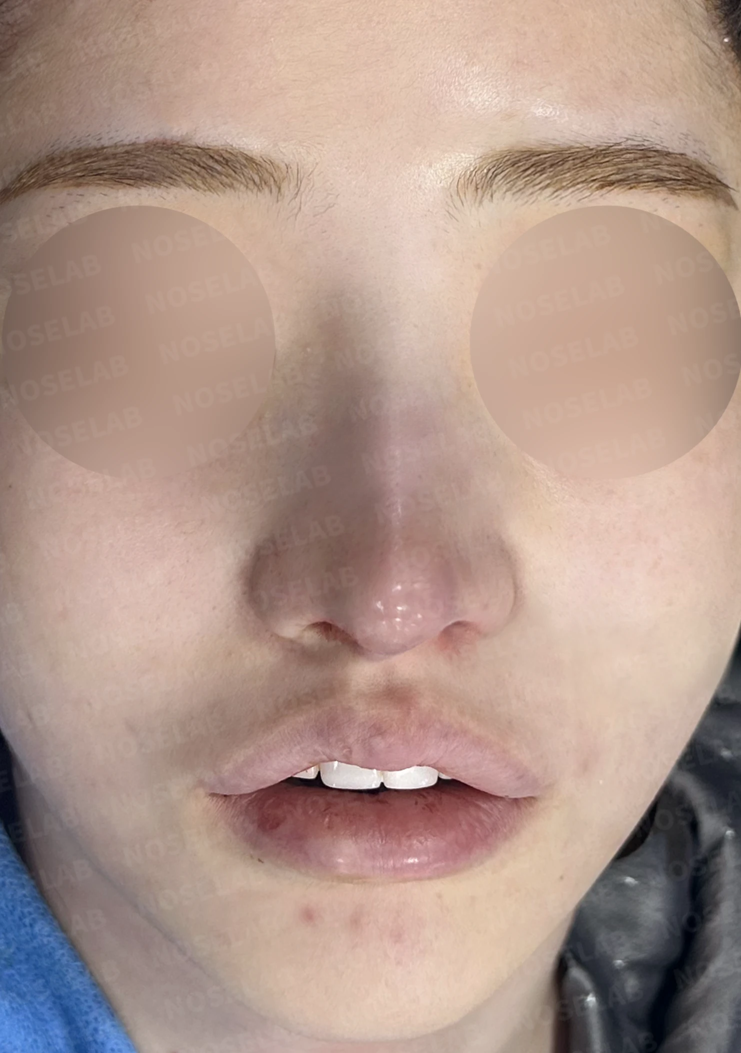 비중격이 심하게 휘고 손상되는 이유, 늑연골 재건은 어떻게 하나 — 수술 전 / 수술 직후 0일 직후 사진은 부기가 있는 상태로 최종 결과와 다를 수 있습니다.