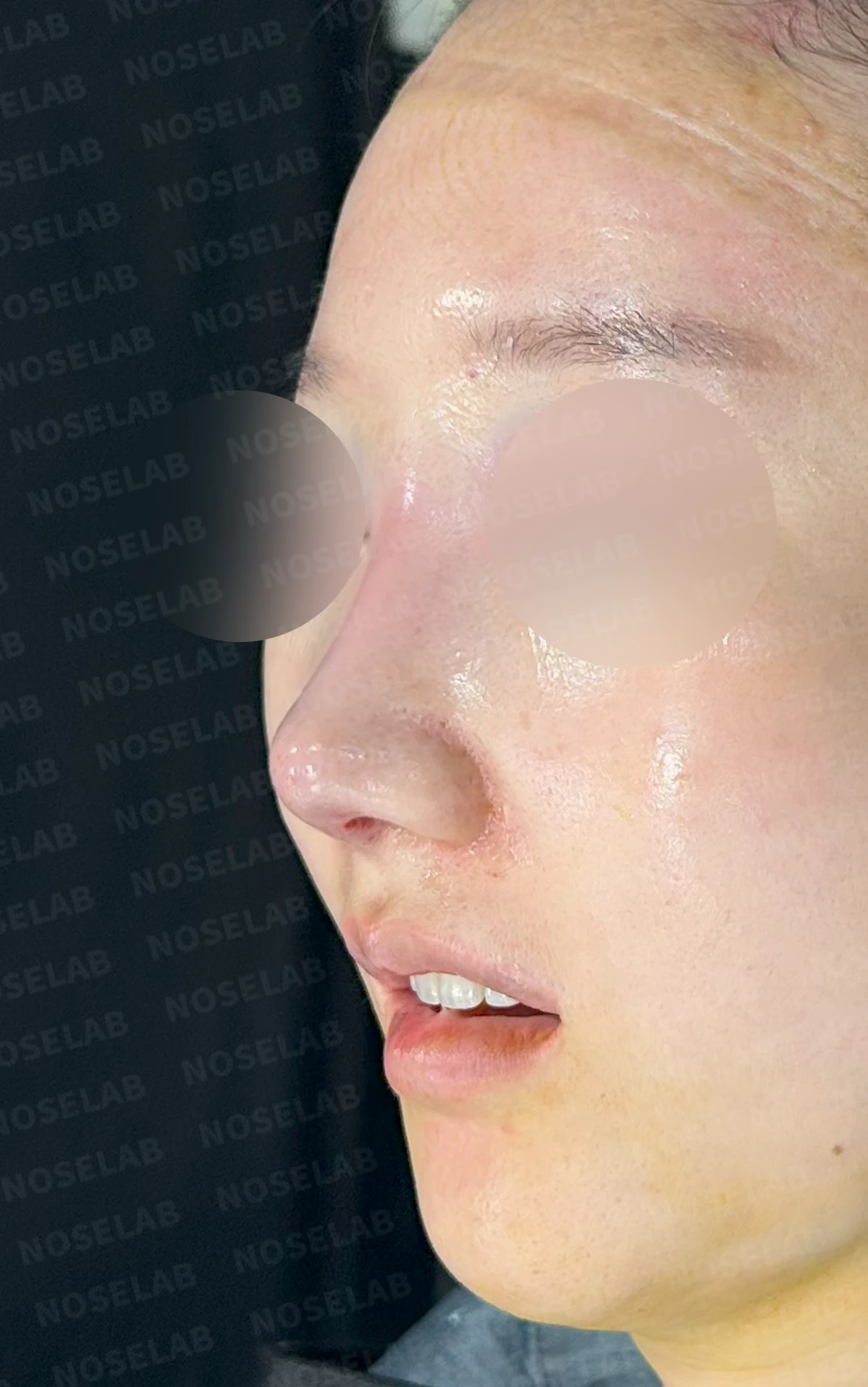 비공 비대칭과 코끝 처짐은 왜 생기나, 연골을 병용한 재건 방법 — 수술 직후 0일 정면, 측면, 비스듬한 측면 사진 직후 사진은 부기가 있는 상태로 최종 결과와 다를 수 있습니다.