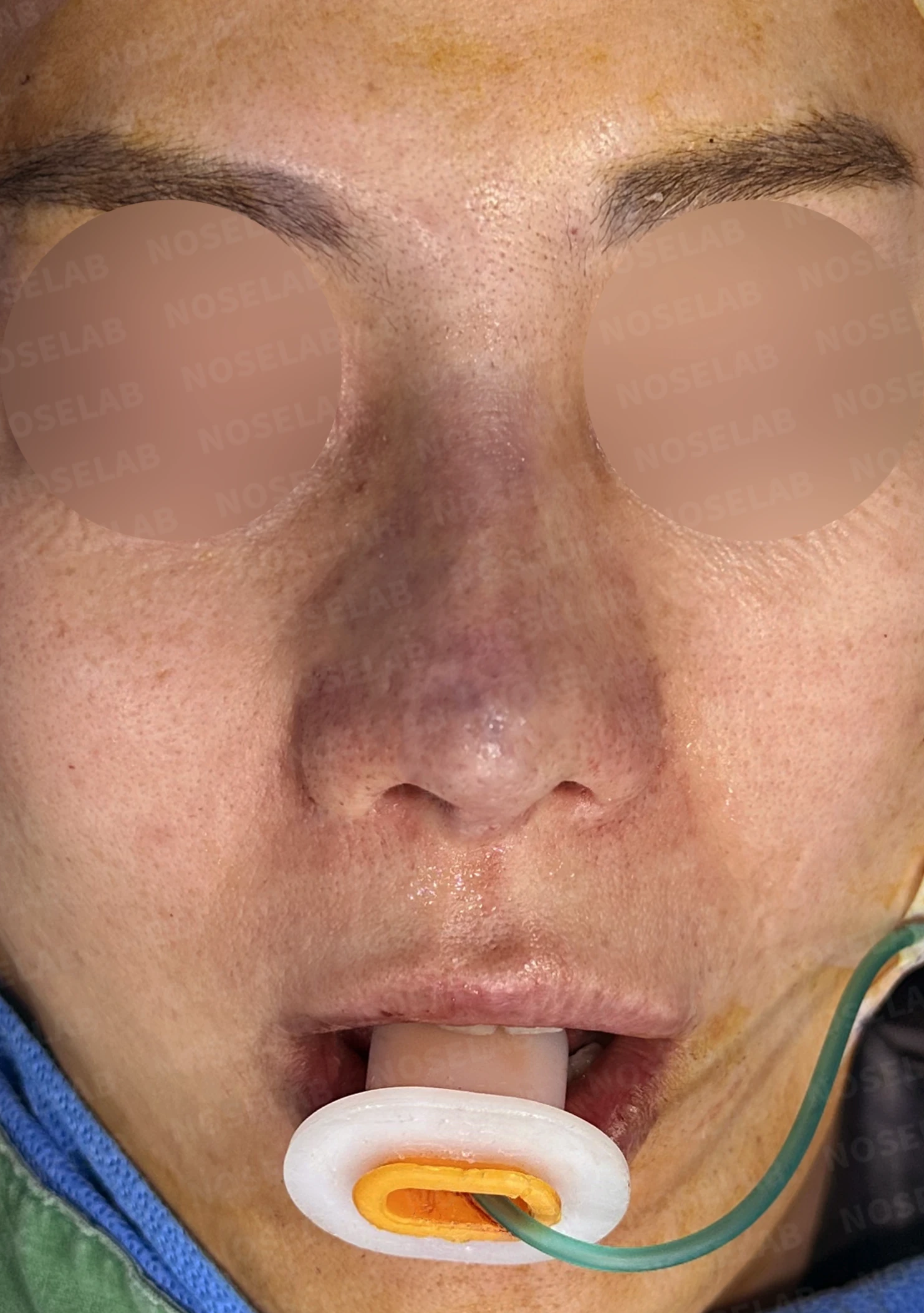 여러 차례 코재수술 후 구축 변형, 자가늑연골로 재건한 사례 — 전(좌) 직후(후)