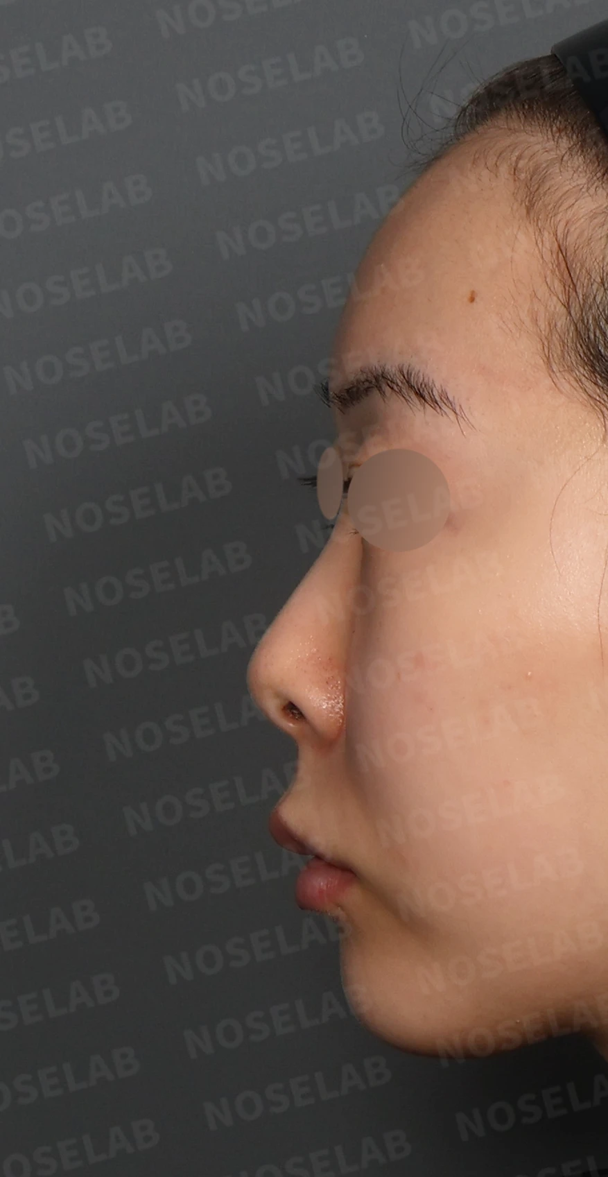 작고 낮은 코, 자가늑연골로 비순각 교정까지 한 번에 완성한 비개방 코성형 — 디자인 상담 정면, 좌측 측면, 비스듬한 측면 사진입니다.