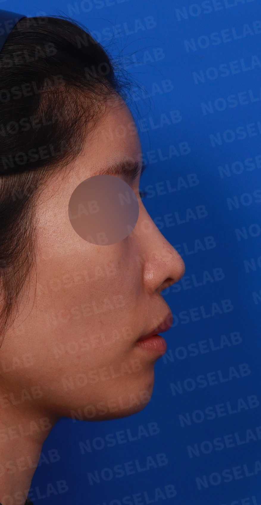 코 수술 뒤 염증이 오래 지속되면 생기는 변화와 재건 방법 — 디자인 상담 우측 측면, 비스듬한 측면, 비공 사진입니다.