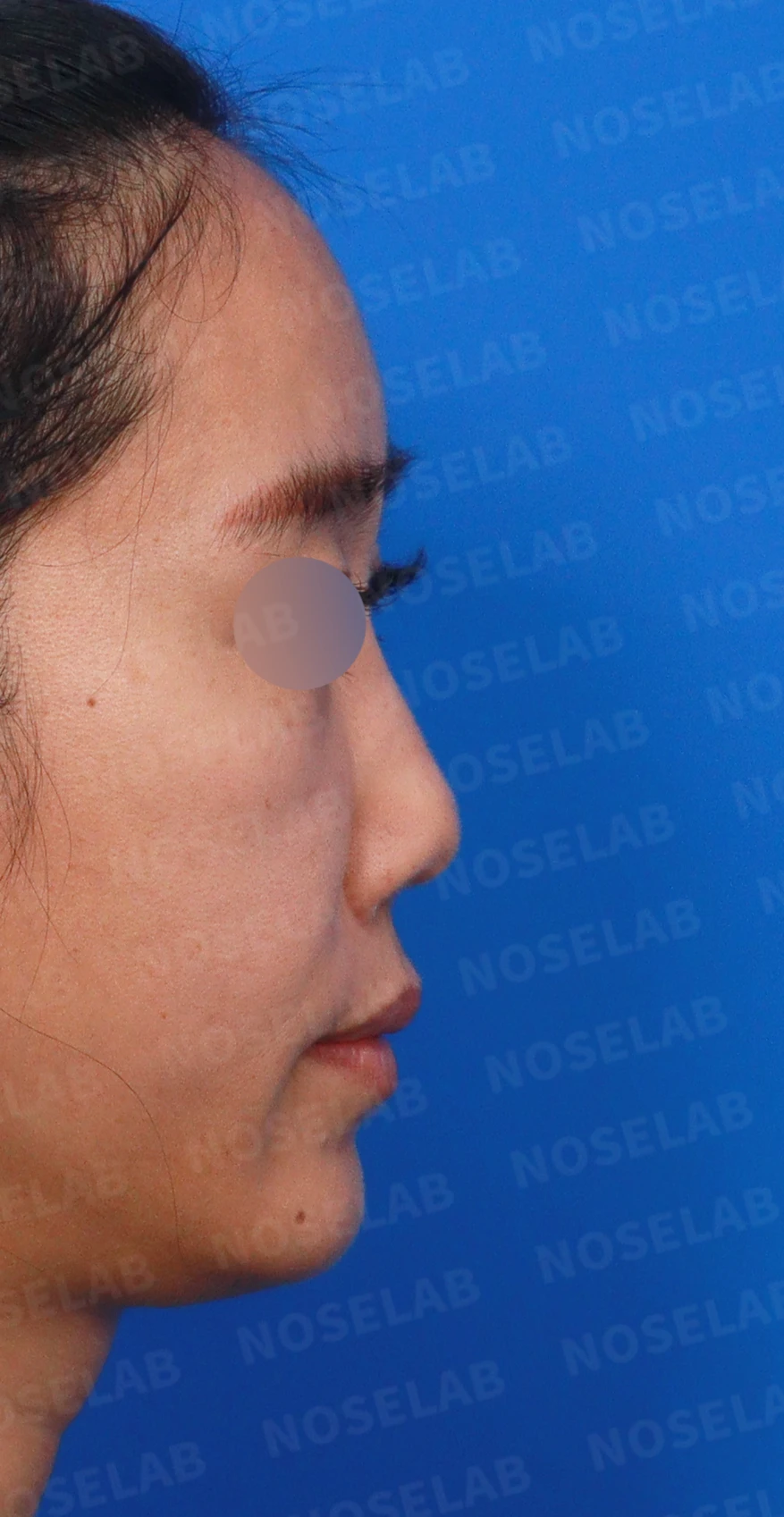 콧대에 주입한 불법 시술 이물질, 제거와 비중격 전체 재건은 어떻게 하나 — 디자인 상담 우측 측면, 비스듬한 측면, 비공 사진입니다.