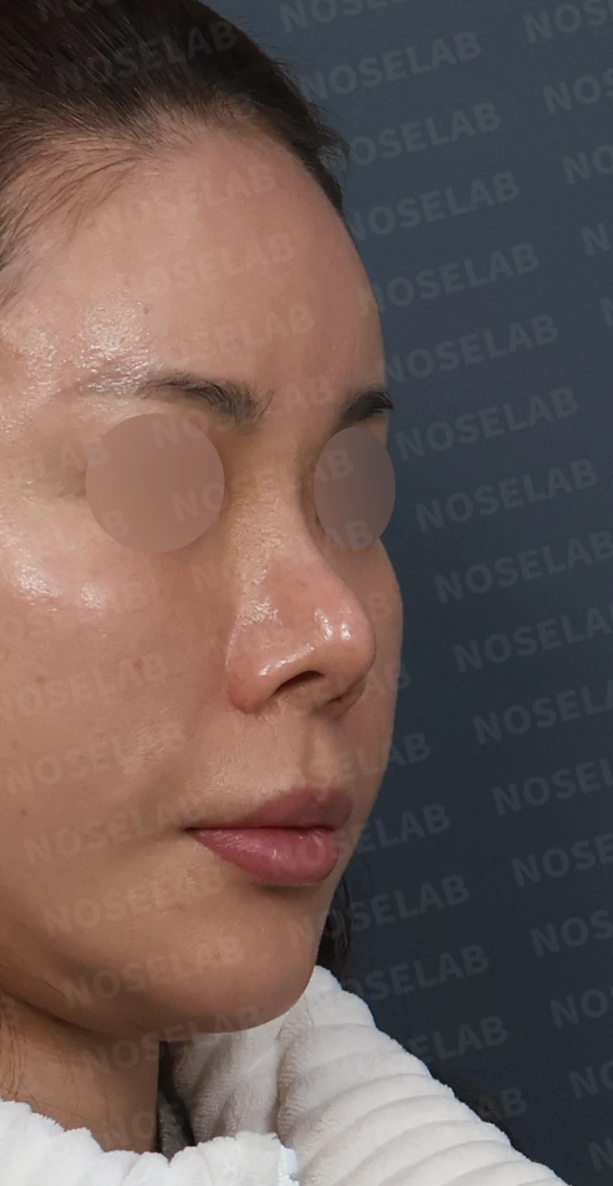 비중격 소실 후 들린 코끝과 찝혀 보이는 콧날개, 자가늑연골로 정밀 재건 — 디자인 상담 우측 측면, 비스듬한 측면, 비공 사진입니다.
