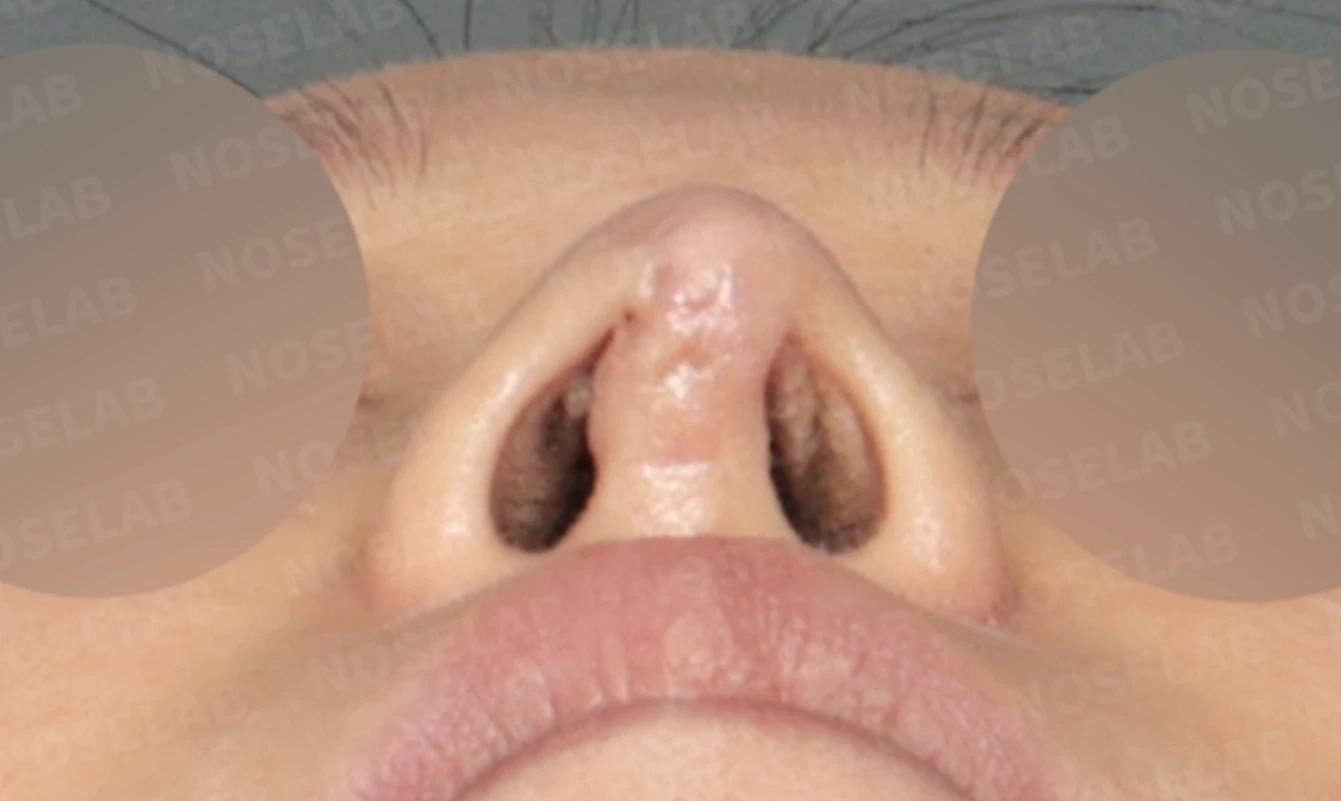 코끝 피부 함몰과 보형물 비침, 자가늑연골로 안전하게 복원한 코재수술 — 전(좌) 직후(우)