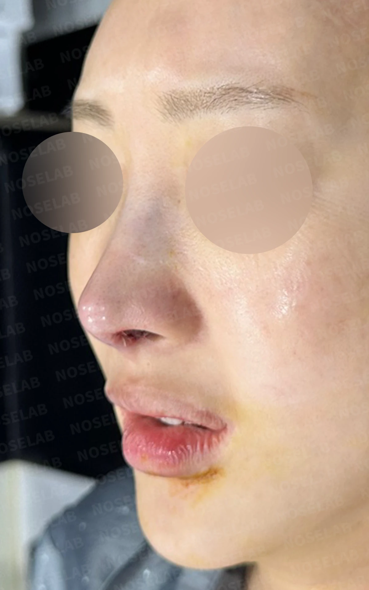 뾰족한 코끝과 연골 비침 - 자가진피 코 재수술 후기 — 전(좌) 직후(우)