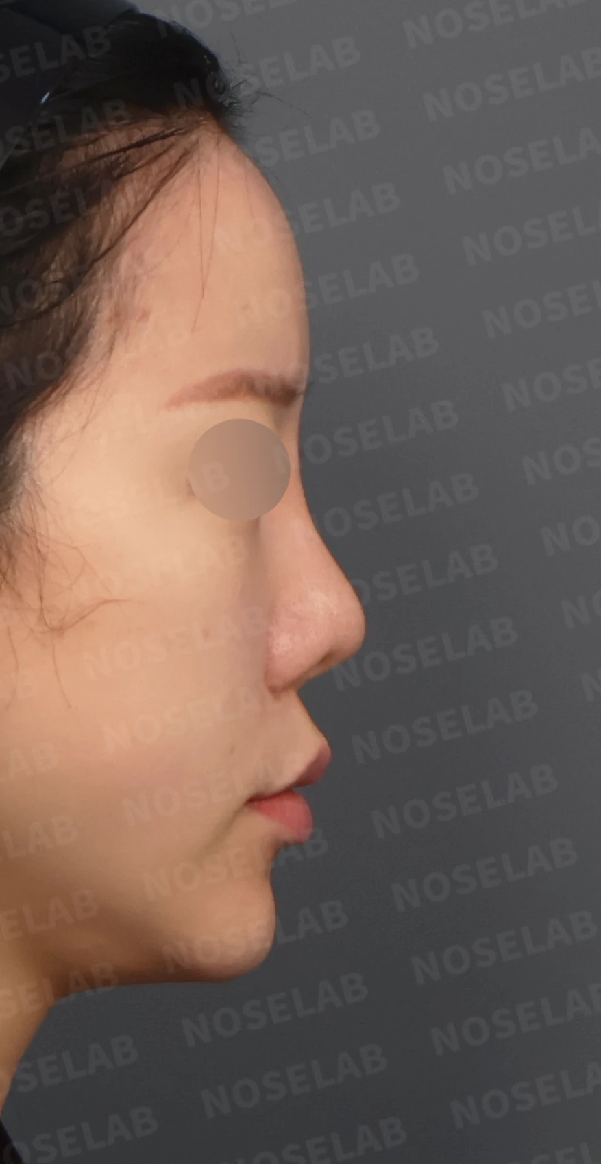 짧은 코와 복코, 자가늑연골로 세련되게 교정한 코재수술 — 디자인 상담 우측 측면, 비스듬한 측면, 비공 사진입니다.