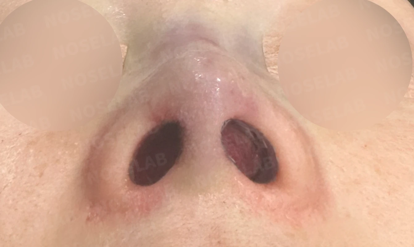오래된 실리콘 피막이 석회화되면 왜 매부리와 휜 코가 생기나 — 본문 사진 14