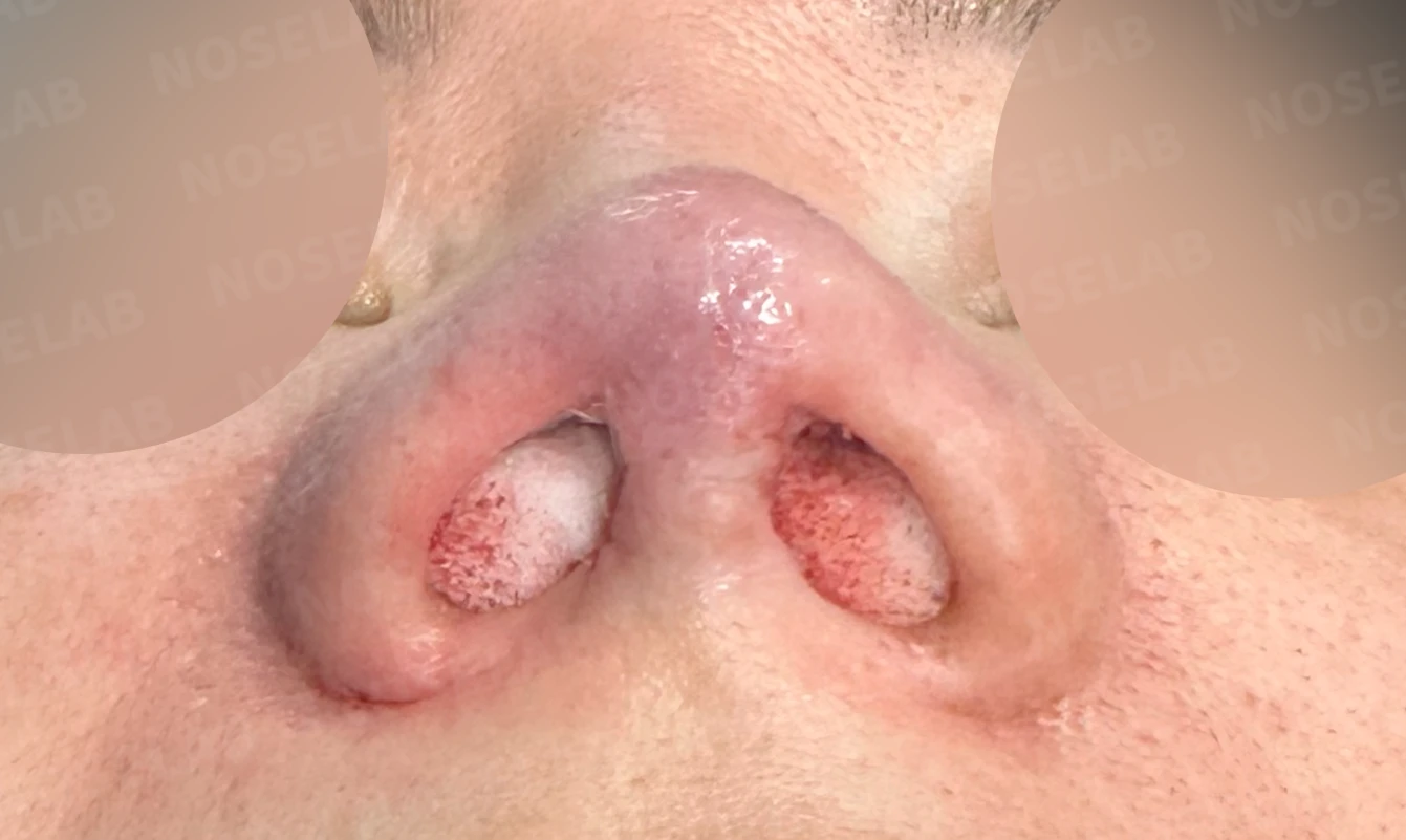 코끝이 찝히고 비주가 함몰되는 이유, 메드포어 제거와 재건은 어떻게 하나 — 수술 전 / 수술 직후 0일 직후 사진은 부기가 있는 상태로 최종 결과와 다를 수 있습니다.