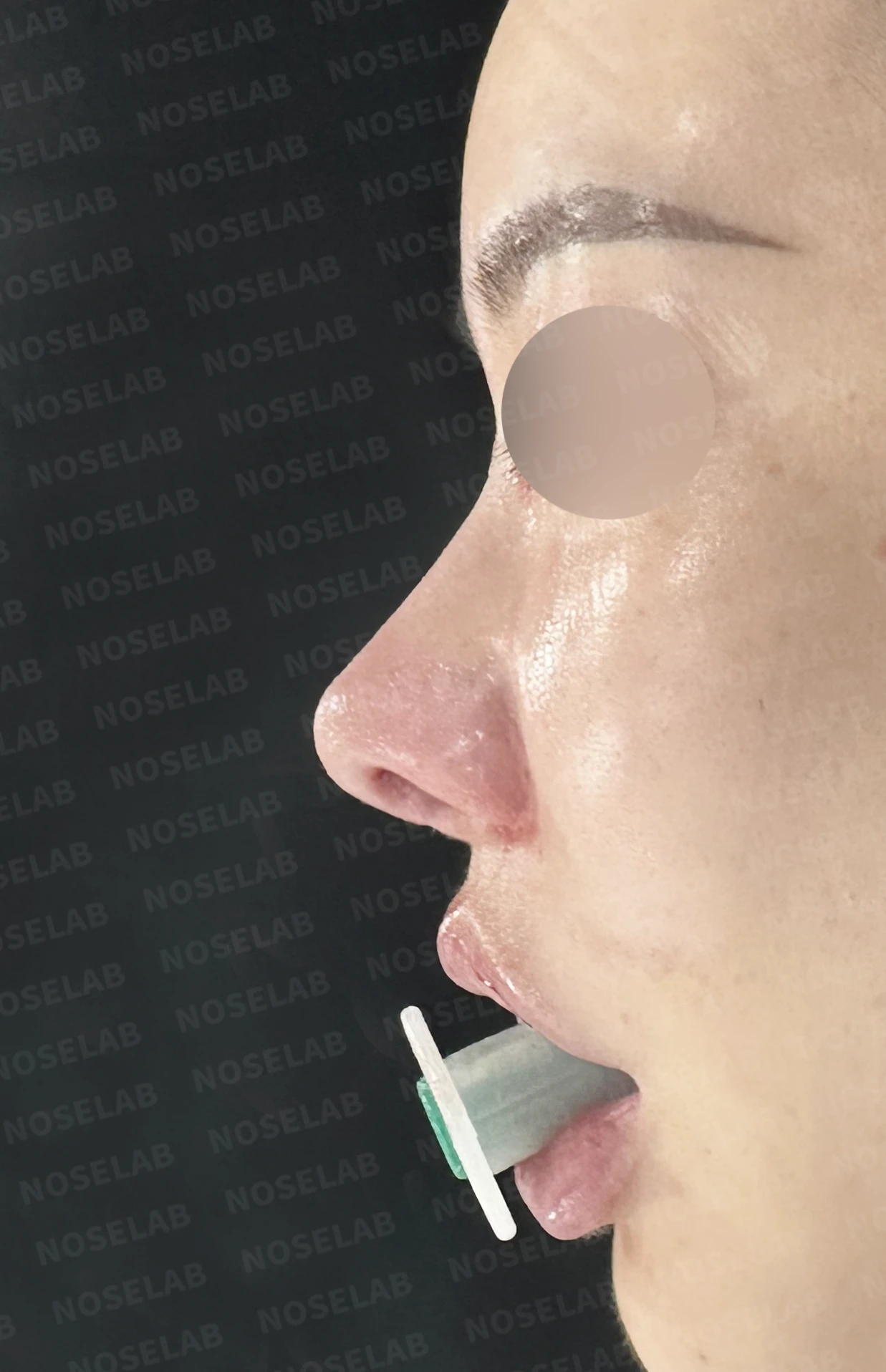 긴 코와 비공 비대칭, 자가늑연골로 자연스럽게 교정한 코재수술 — 직후 정면, 비스듬한 측면, 측면 사진