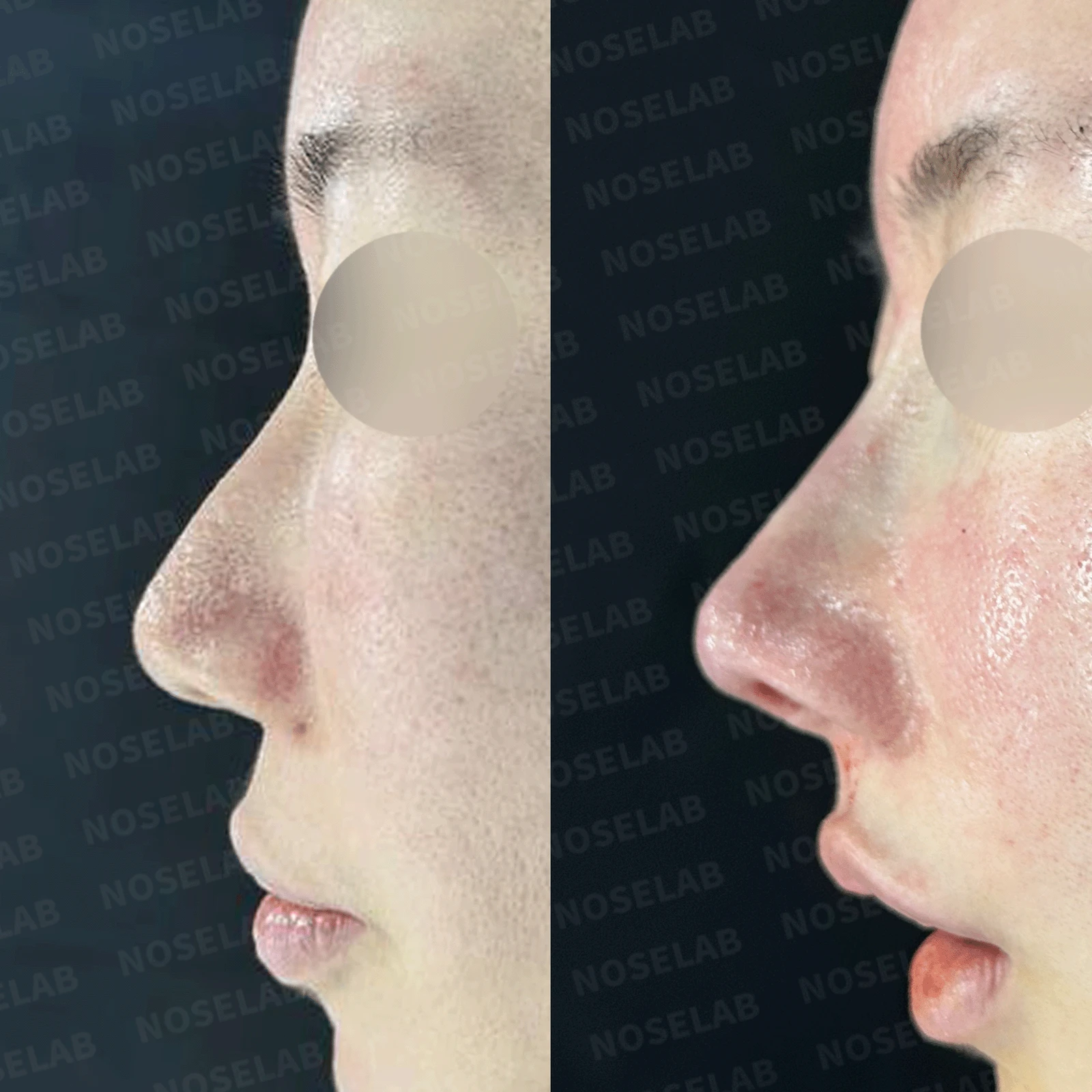 오래된 코 수술 뒤 비주가 함몰되고 코끝이 뭉툭해지는 이유와 재건 방법 — 본문 사진 20