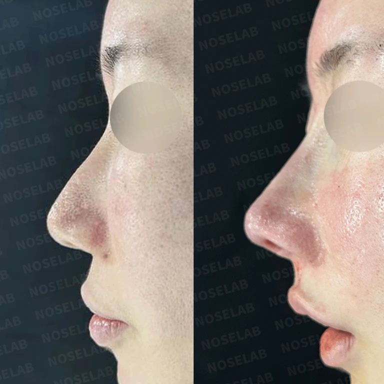 14년된 함몰된 비주 복원과 뭉툭한 코끝 교정 - 자가늑연골 후기 — 전후 비교