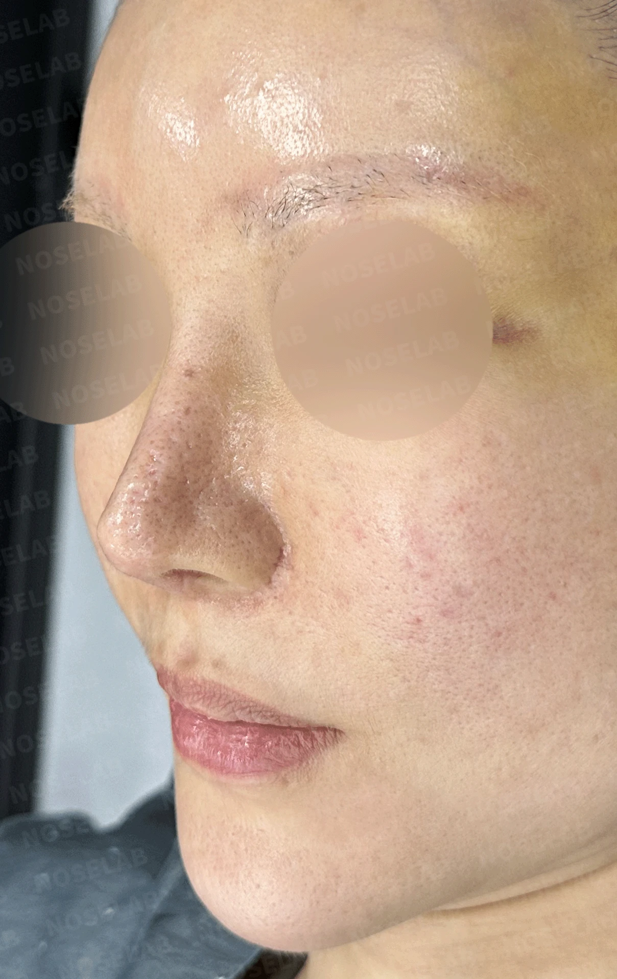여러 차례 재수술로 코에 쓸 연골이 남지 않았을 때, 재건은 어떻게 하나 — 본문 사진 11
