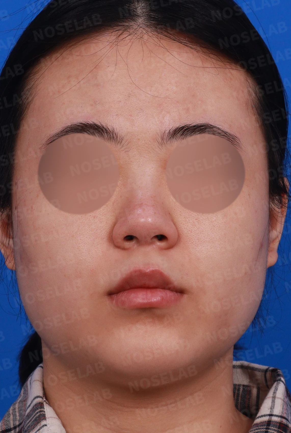 코끝 피부가 두껍고 잘 늘어나지 않는 코에서 높이와 직반 라인을 만드는 방법 — 디자인 상담 정면, 좌측 측면, 비스듬한 측면 사진