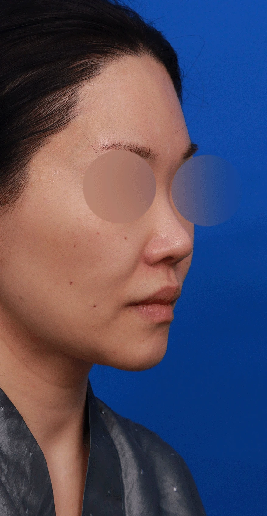인공진피가 흡수되며 콧대가 낮아지고 퍼지는 이유 — 디자인 상담 우측 비스듬한 측면, 측면, 비공 사진입니다.