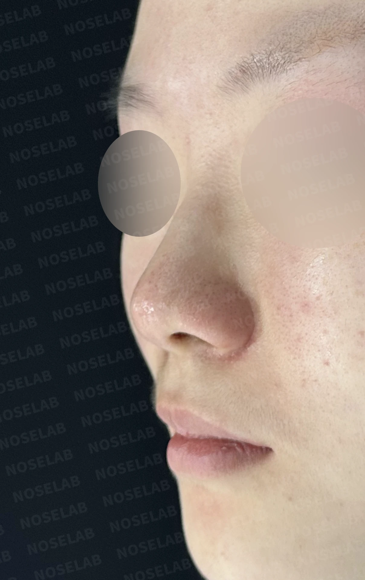 콧대가 퍼져 보이고 코끝이 뭉툭한 이유, 절골술과 자가 늑연골 교정은 어떻게 하나 — 수술 전 / 수술 직후 0일 직후 사진은 부기가 있는 상태로 최종 결과와 다를 수 있습니다.