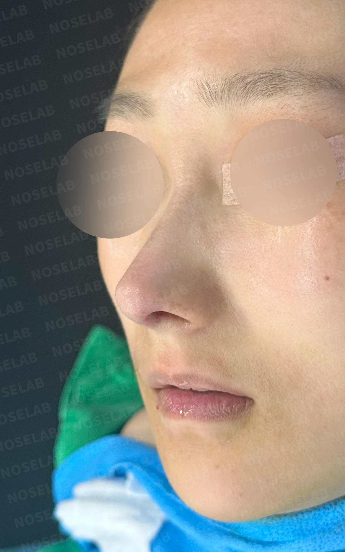 코가 한쪽으로 휘어 보이고 밤에 막히는 이유, 비중격 재건과 코막힘 개선 — 본문 사진 12
