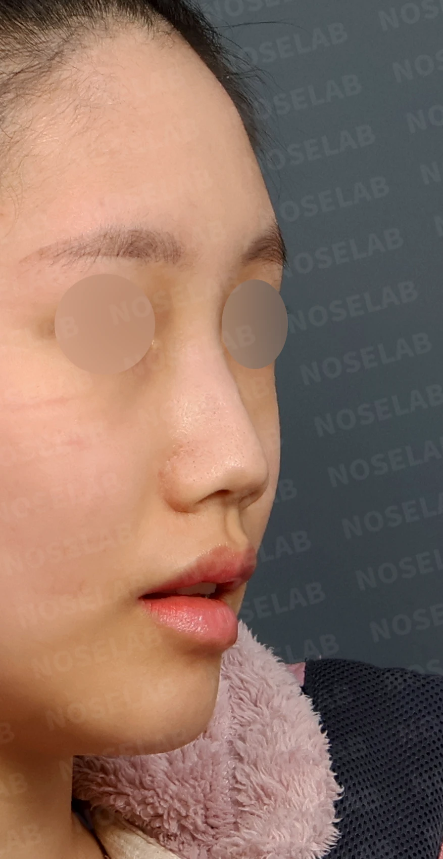 무보형물 코성형, 휘어진 콧대와 처진 코끝을 자연스럽게 교정 — 디자인 상담 우측 측면, 비스듬한 측면, 비공 사진입니다.