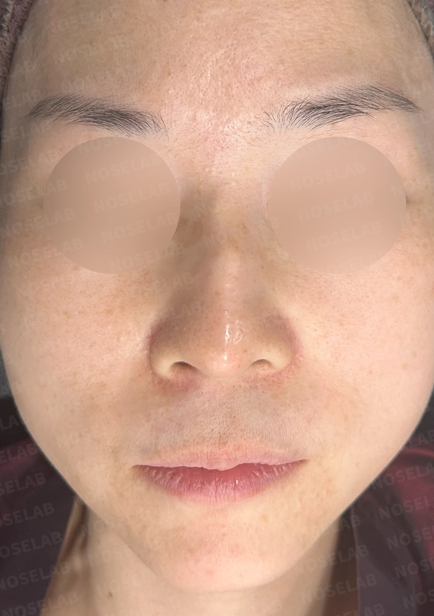 오래된 실리콘 피막이 석회화되면 왜 매부리와 휜 코가 생기나 — 본문 사진 7