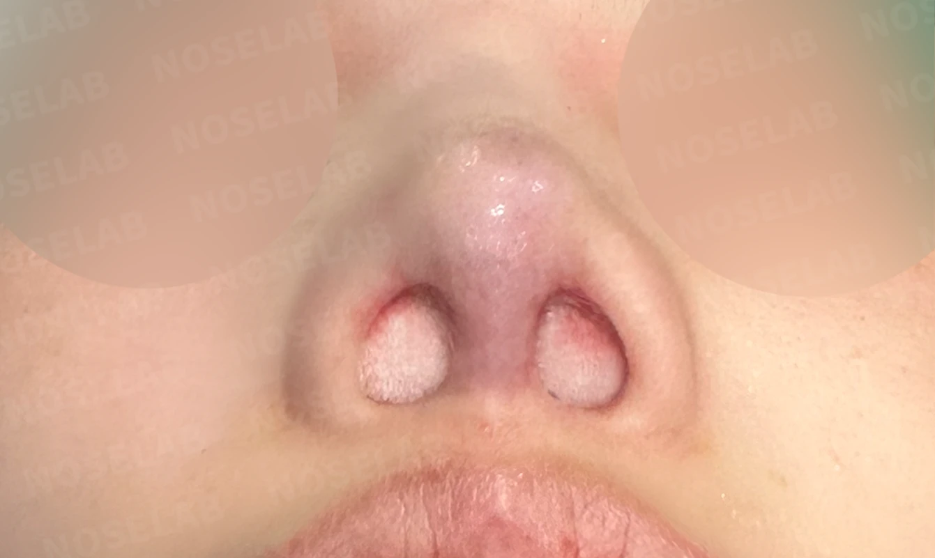 보형물을 넣고 빼기를 반복한 코에 남는 콧등 패임과 들린 느낌 — 수술 직후 0일 비공 사진입니다. 직후 사진은 부기가 있는 상태로 최종 결과와 다를 수 있습니다.