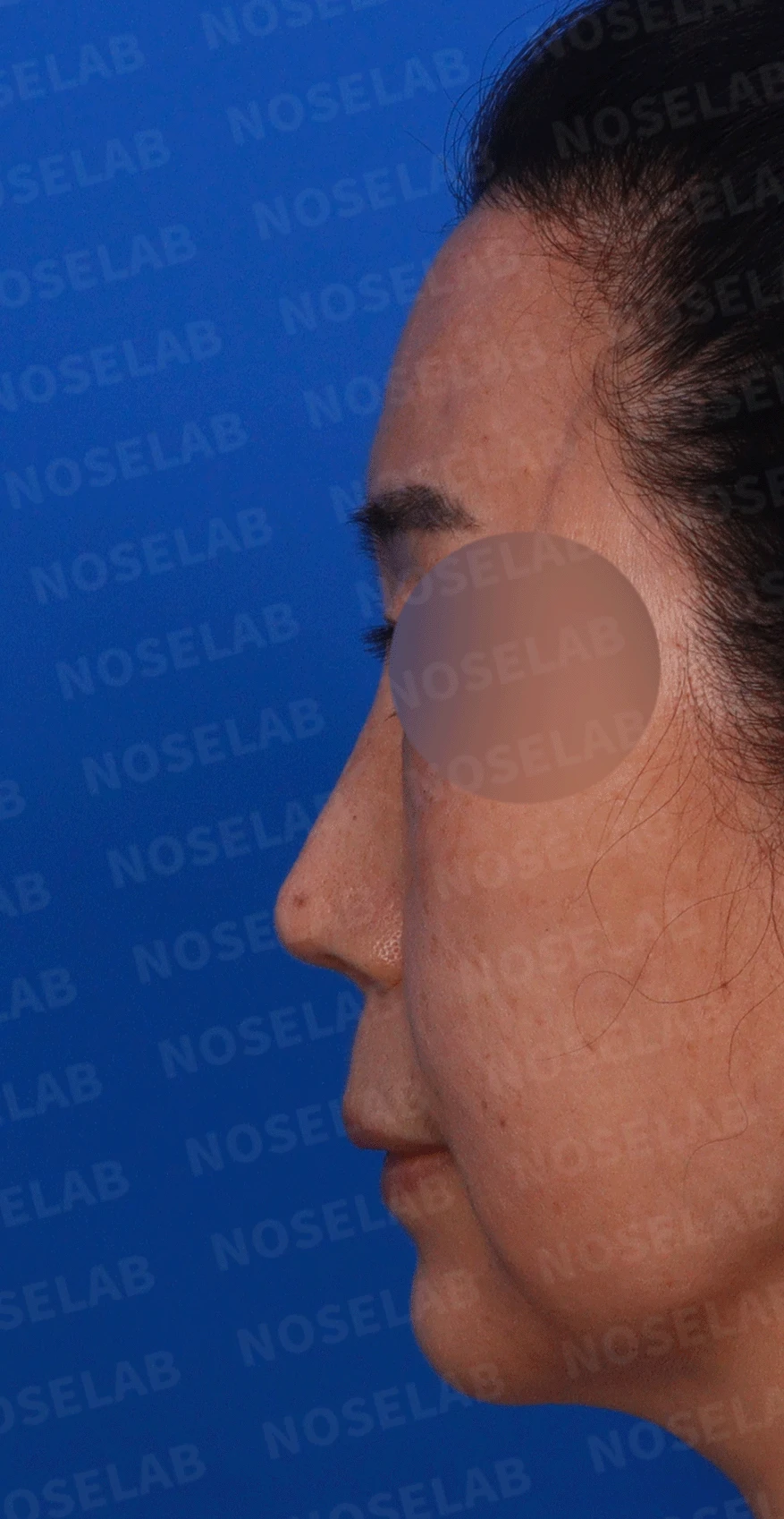 여러 차례 수술에도 코가 계속 휘는 이유, 비중격 연골 재건 방법 — 디자인 상담 정면 , 좌측 비스듬한 측면 , 측면 사진입니다.