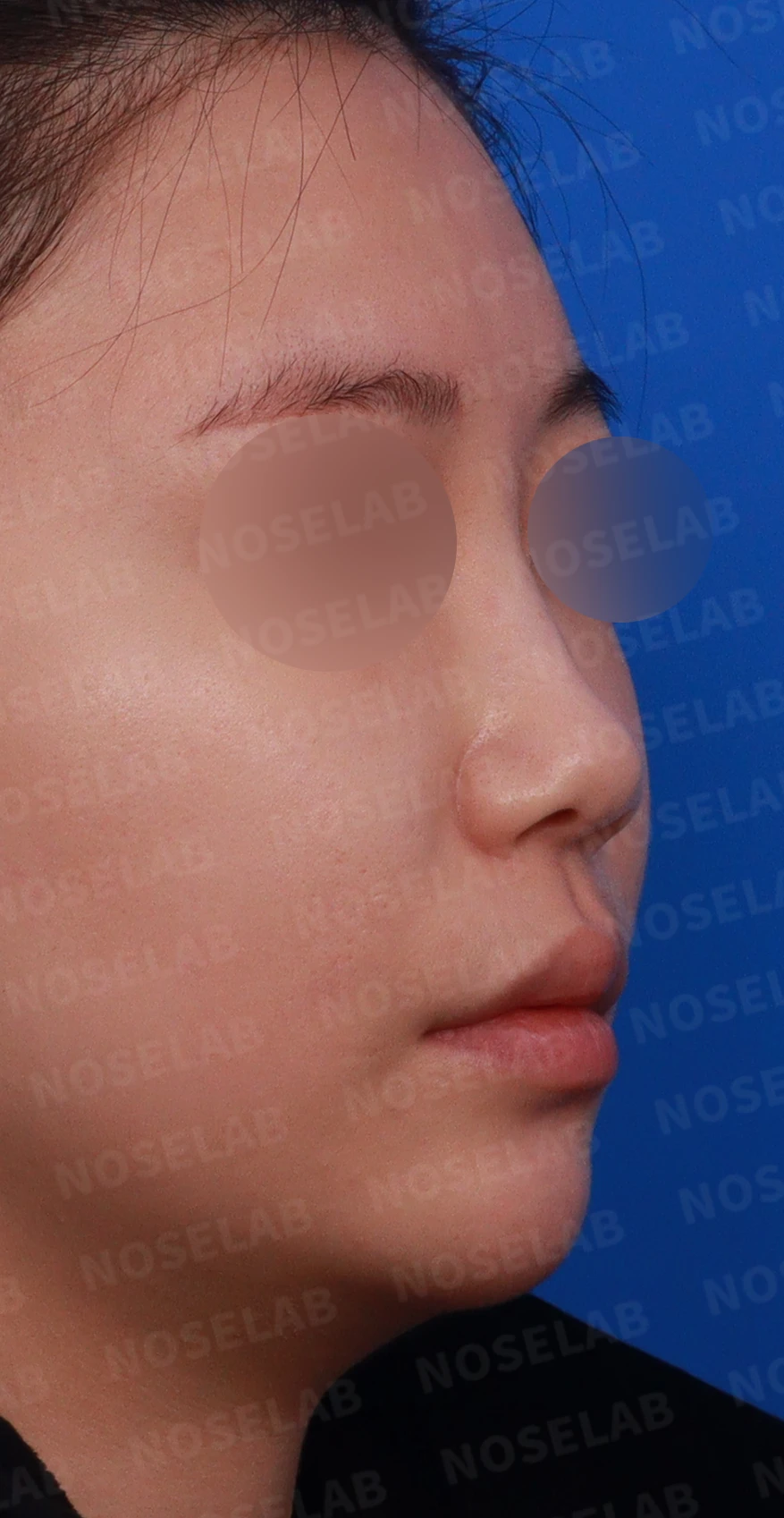 필러와 실이 남아 있는 코, 제거 후 늑연골 재건은 어디까지 가능한가 — 디자인 상담, 우측 비스듬한 측면, 측면, 비공 사진