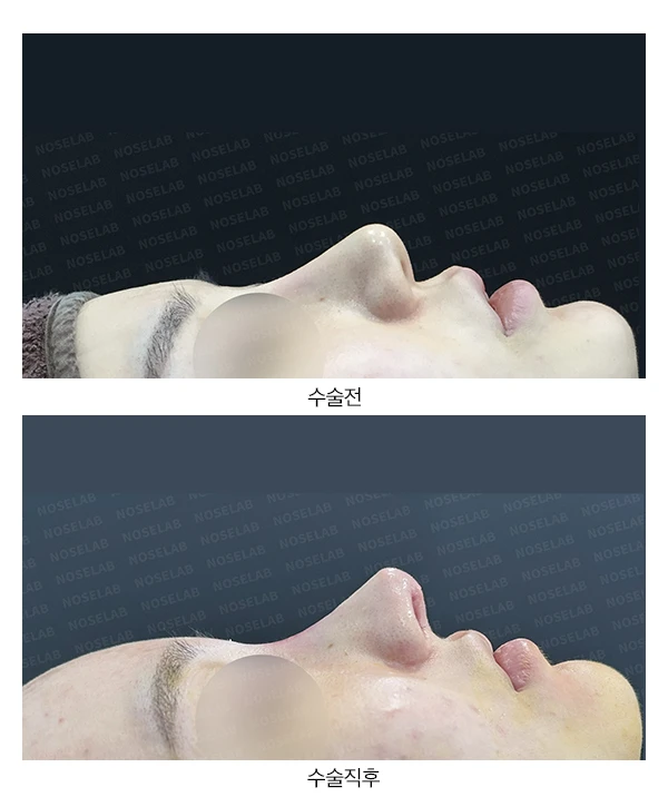 콧대 시작점과 비주를 함께 낮추는 교정 방법 — 본문 사진 13
