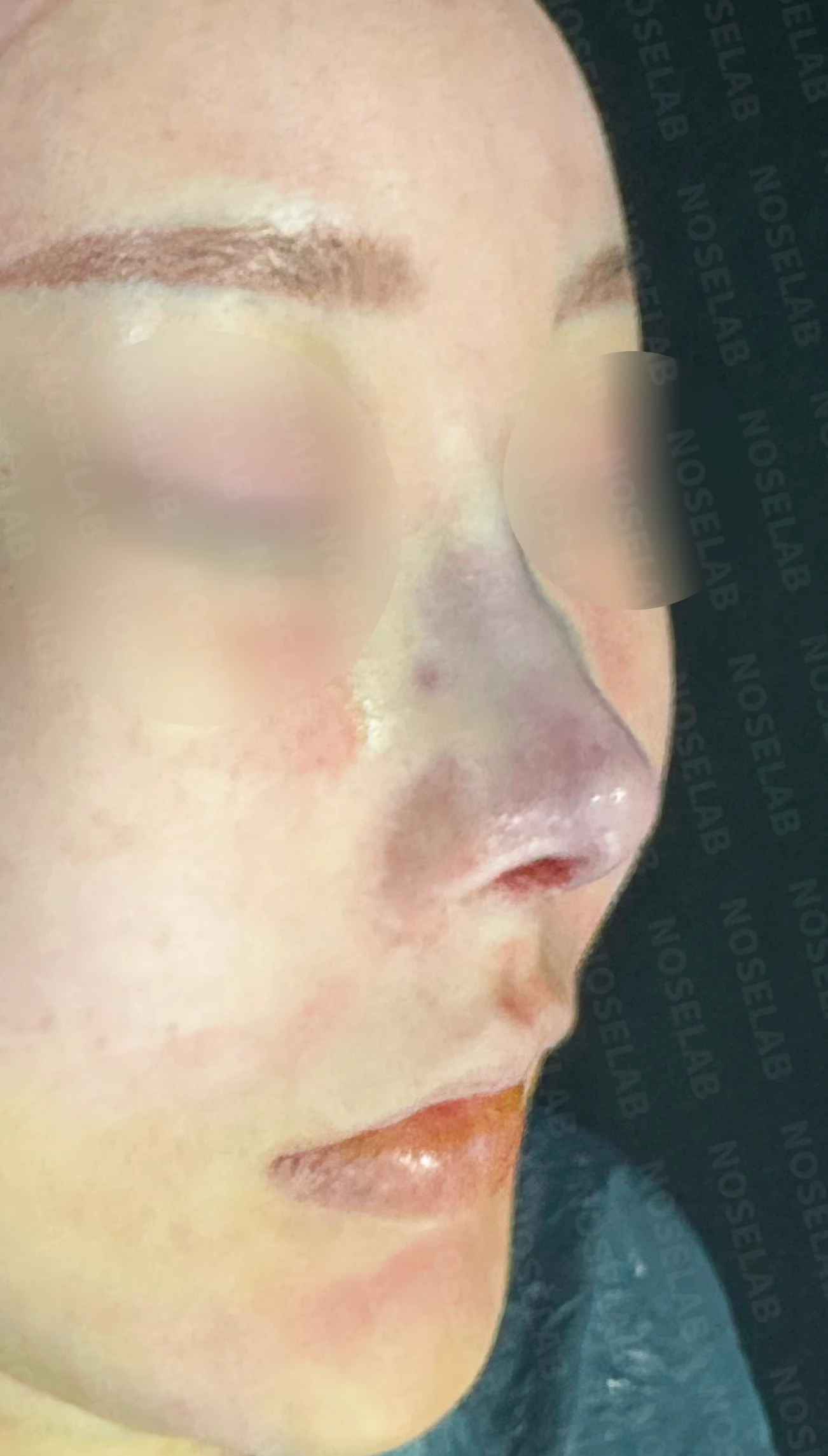 비주 함몰과 복코, 비공 비대칭의 교정 방법 — 수술 직후 0일 정면, 비스듬한 측면, 측면 직후 사진은 부기가 있는 상태로 최종 결과와 다를 수 있습니다.