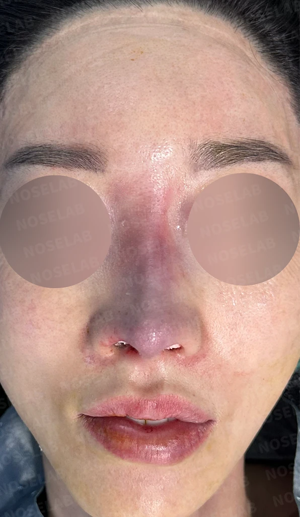 긴코 교정은 어떻게 할까요? — 수술 전 / 수술 직후 0일 직후 사진은 부기가 있는 상태로 최종 결과와 다를 수 있습니다.