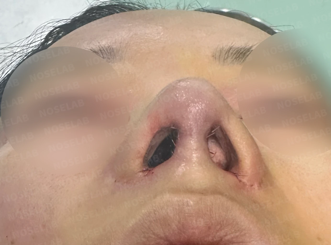비공 비대칭, 퍼진코! 코재수술 사례 — 전(좌) 직후(우)