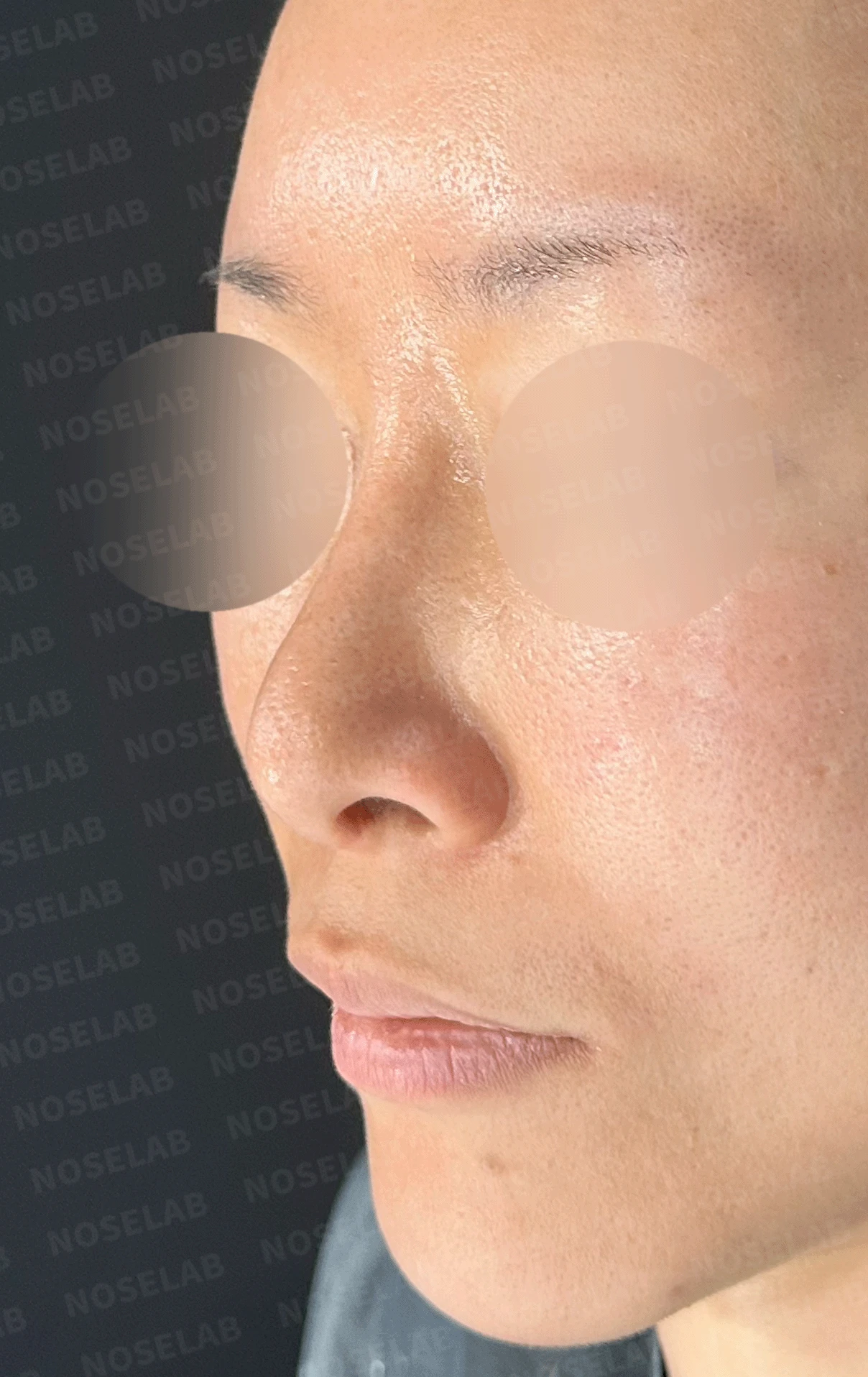 후비루와 코끝 처짐이 함께 나타나는 이유, 비중격 연장과 기능 수술은 어떻게 하나 — 본문 사진 11