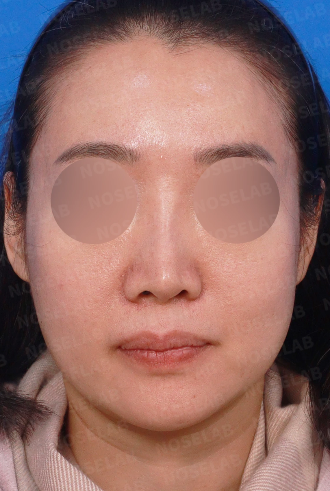 비중격이 한쪽으로 무너지면 코가 휘고 숨이 막히는 이유, 자가늑연골 재건 방법 — 디자인 상담 정면, 좌측 측면, 비스듬한 측면 사진입니다.