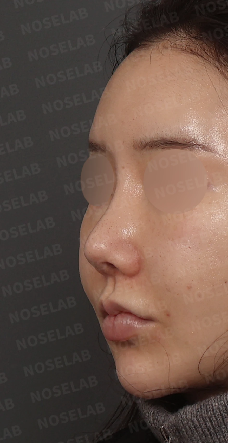 휘어진 코와 비공 비대칭, 자가늑연골 비중격 재건으로 완성한 코재수술 — 디자인 상담 정면, 좌측 측면, 비스듬한 측면 사진