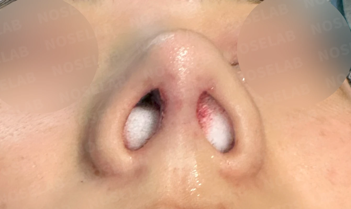 코뼈 비대칭과 처진 코끝에 만성 비염이 겹칠 때 보는 것 — 수술 직후 0일 비공 사진입니다. 직후 사진은 부기가 있는 상태로 최종 결과와 다를 수 있습니다.