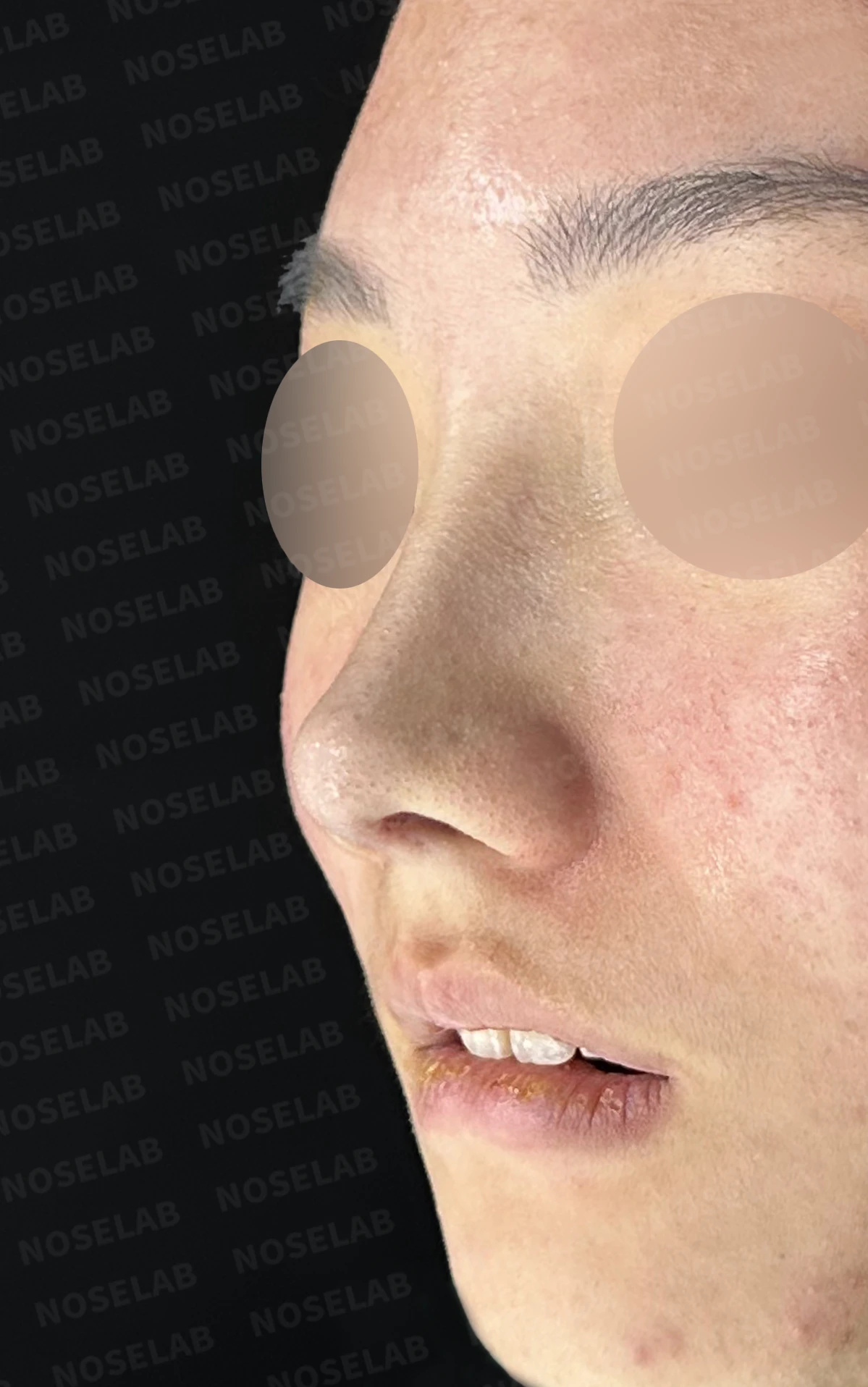 콧대가 낮고 코끝이 뭉툭해 보이는 이유, 함몰된 비주와 함께 교정하는 방법 — 수술 전 / 수술 직후 0일 직후 사진은 부기가 있는 상태로 최종 결과와 다를 수 있습니다.
