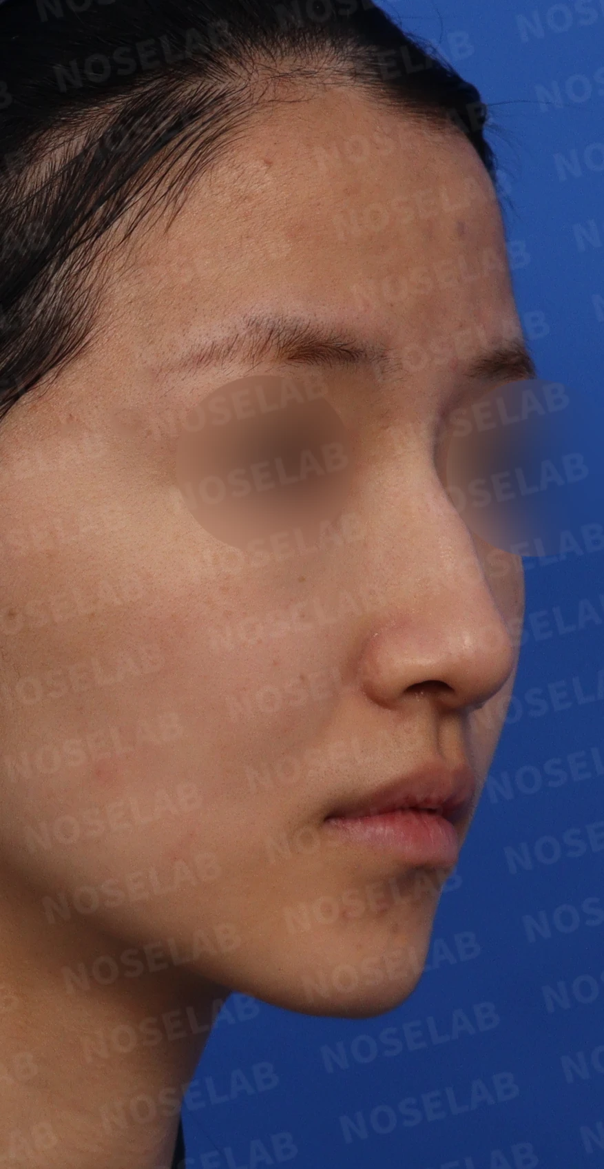 긴 코와 매부리코, 얼굴 비율을 고려한 교정 방법 — 디자인 상담 정면, 우측 비스듬한 측면, 측면 사진입니다.