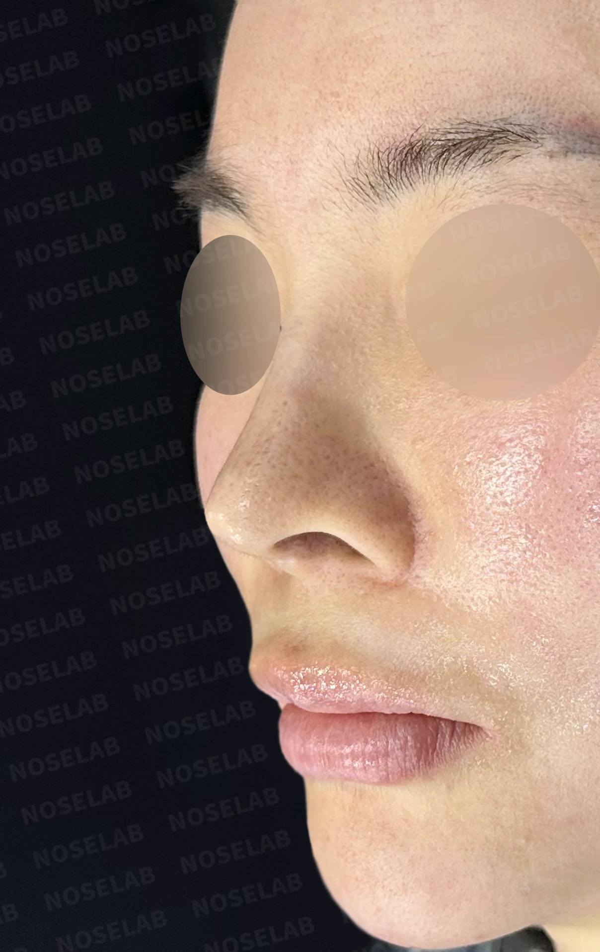 여러 차례 수술 뒤 코막힘이 남는 이유, 비중격과 비밸브 재건은 어떻게 하나 — 수술 전 / 수술 직후 0일 직후 사진은 부기가 있는 상태로 최종 결과와 다를 수 있습니다.