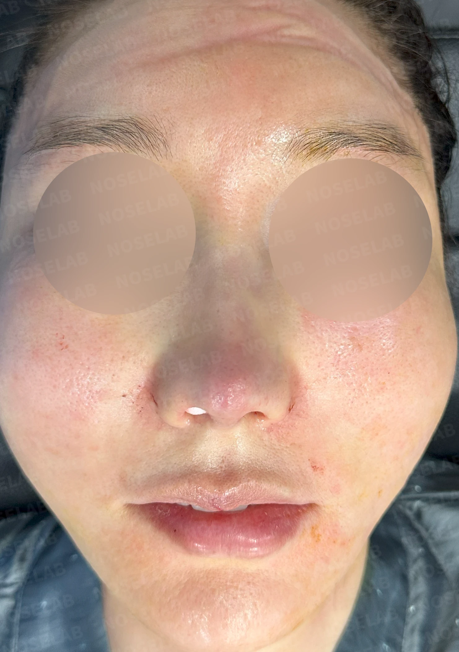매부리를 깎은 뒤 다시 매부리가 보이고 콧구멍이 드러나는 이유 — 수술 전 / 수술 직후 0일 직후 사진은 부기가 있는 상태로 최종 결과와 다를 수 있습니다.
