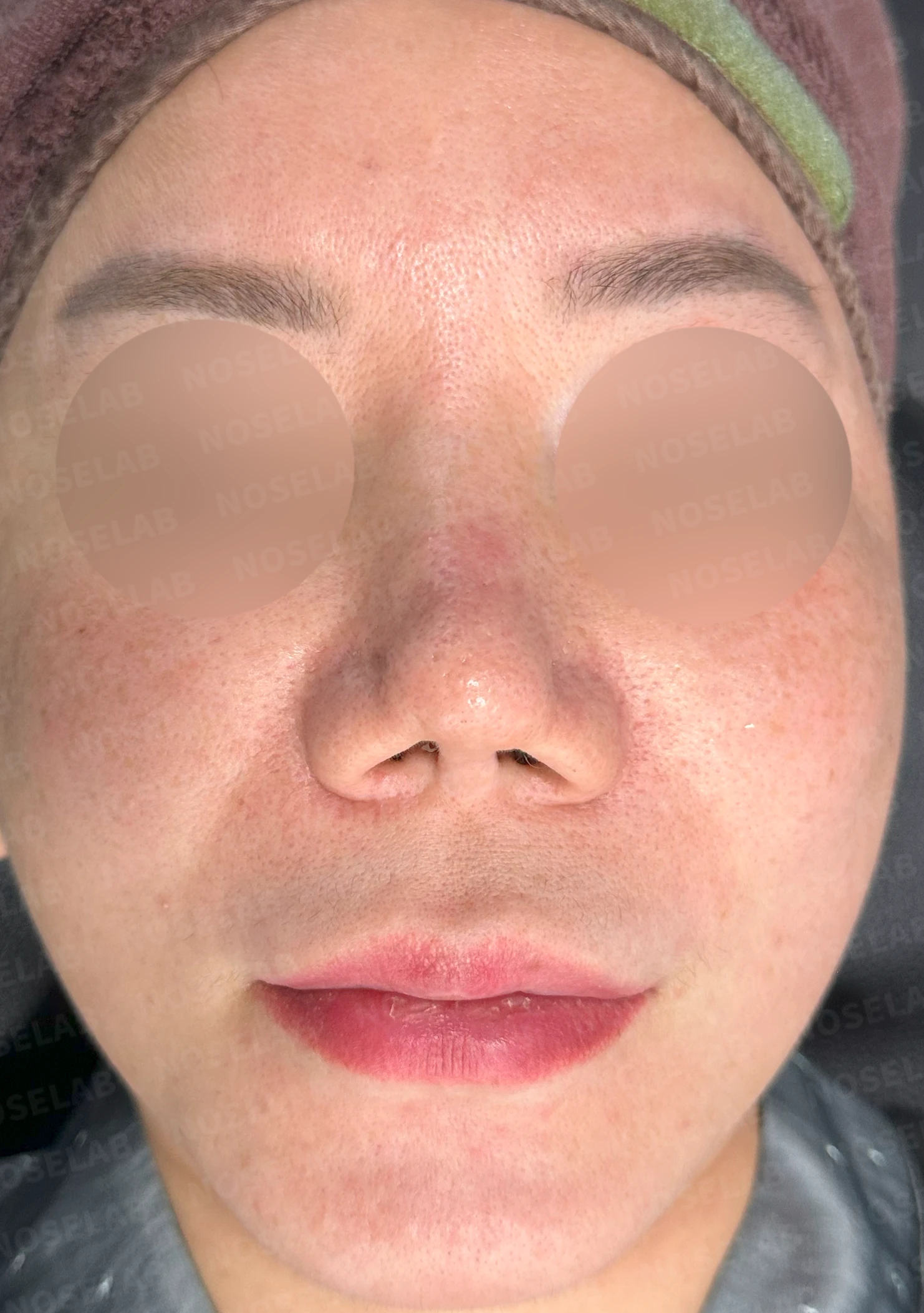 코끝이 찝히고 비주가 함몰되는 이유, 메드포어 제거와 재건은 어떻게 하나 — 수술 전 / 수술 직후 0일 직후 사진은 부기가 있는 상태로 최종 결과와 다를 수 있습니다.