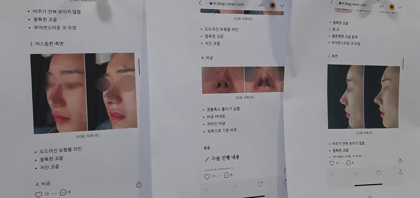 오래된 고어텍스 구축과 비중격 천공이 생기는 이유, 재건은 어떻게 하나 — 본문 사진 7