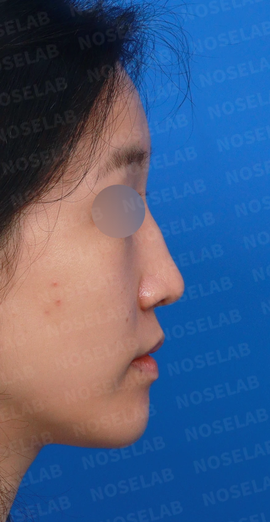 콧대 인공진피가 매부리로 남는 이유와 제거 후 재건 방법 — 디자인 상담 우측 측면, 비스듬한 측면, 비공 사진입니다.