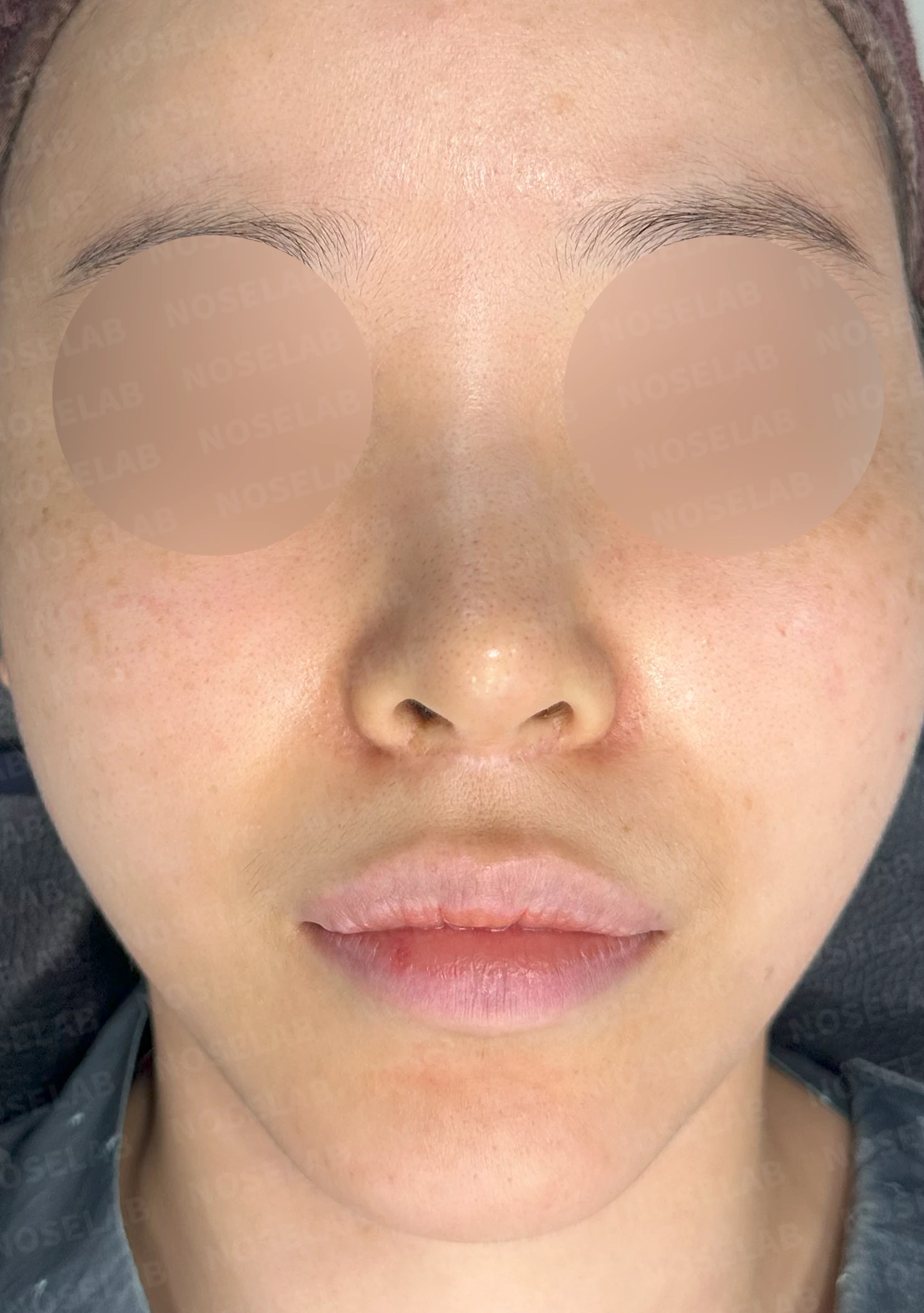 귀연골만으로 코끝을 받쳤을 때 생기는 변화와 늑연골 재건 방법 — 본문 사진 7