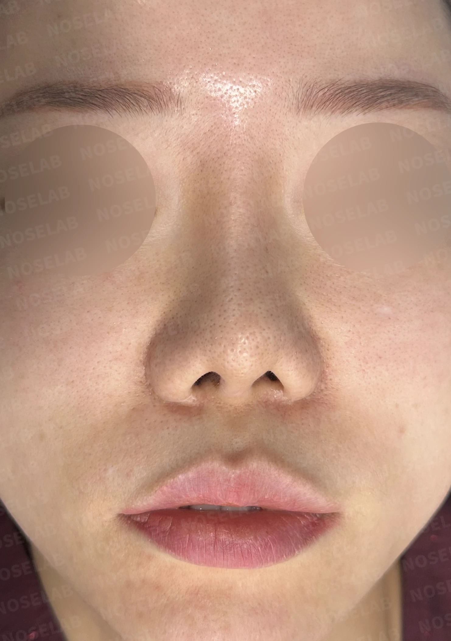 짧은 코와 복코, 자가늑연골로 세련되게 교정한 코재수술 — 전(좌) 직후(후)